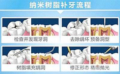 專(zhuān)業(yè)補(bǔ)牙過(guò)程是怎樣的？