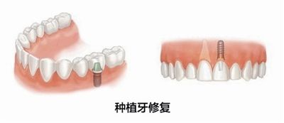 深圳鑲牙一般需要多少錢？