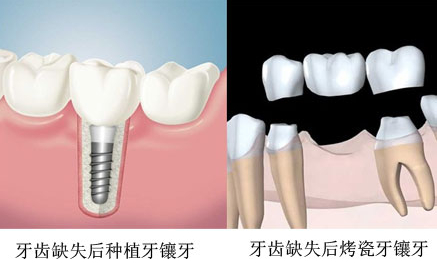 鑲牙多長時間可以完事？