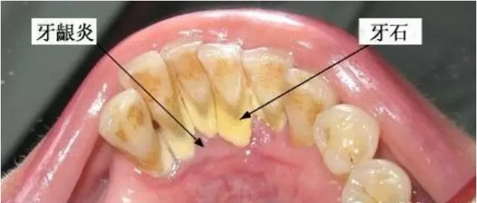 左氧氟沙星可以治療牙齦炎嗎？