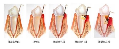 重度牙齦炎的癥狀有哪些？