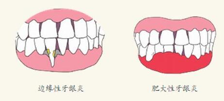 增生性牙齦炎的癥狀有哪些？