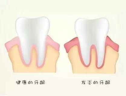 正常牙齦和牙齦炎的區(qū)別有哪些？