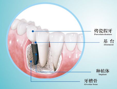 深圳一般種植牙多少錢(qián)？