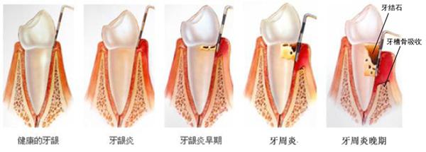 怎么治療牙齦炎？