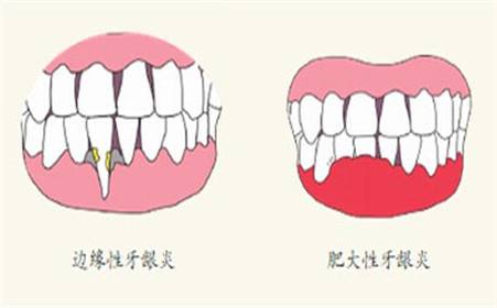 孕期牙齦炎怎么治療？