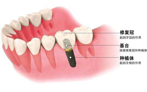 深圳一般種植牙價(jià)格是多少？