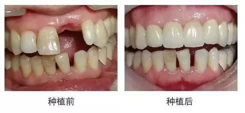 深圳一顆種植牙需要多少錢？