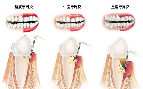 牙周炎癥狀怎么治療？