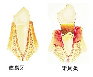 牙周炎癥狀怎么治療？