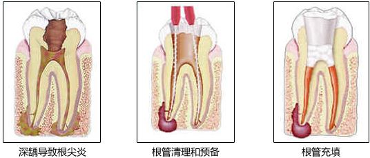 深圳牙齒根管治療費(fèi)用是多少？