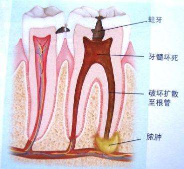 深圳牙齒根管治療費(fèi)用是多少？