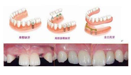 牙齒沒了怎么修復(fù)比較好？