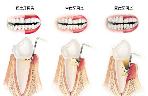 嚴(yán)重的牙周炎怎么辦？